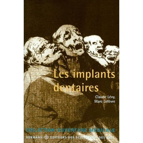 Les Implants Dentaires