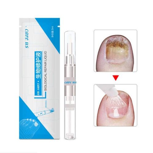 3ml Stylo À Ongles Orteil Doigt Ongles Santé À Base De Plantes Liquide Soins De Beauté Pour Onychomycosis Paronychia Traitement De L'infection 