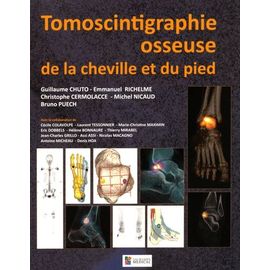 Tomoscintigraphie Osseuse De La Cheville Et Du Pied