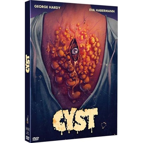Cyst