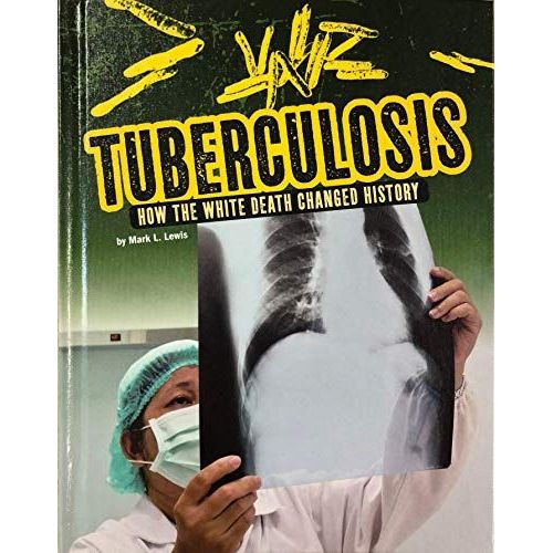 Tuberculosis