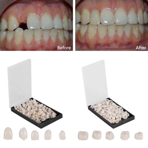 120pcs Matériel dentaire Dents Mixte Couronne temporaire 70pcs Dents  antérieures 50pcs Molaire Facettes postérieures Dents Outil de dentiste