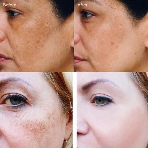 2 Achetés 1 Offert - Crème Blanchissante Pour Taches De Rousseur, Élimine Efficacement Le Melasma, Élimine Les Taches Foncées, Hydrate La Mélanine, Éclaircit, Lisse, Soins Pour La Peau Du Visage, 10 Pièces