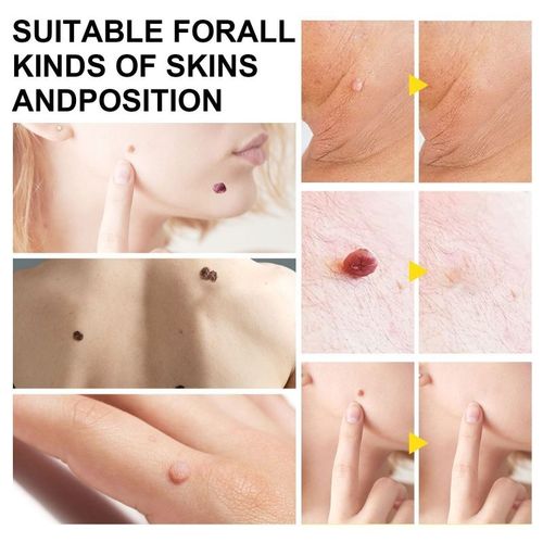 Dispositif Dissolvant D'étiquettes De Peau Pour Les Grandes Étiquettes De Peau, Comprend Des Bandes D'élimination Lingettes Nettoyantes Application En Quelques Minutes Pour Femmes Hommes 