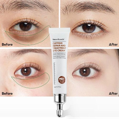 Crème Anti-Âge Pour Les Yeux, 20g, 1 Pièce, Acide Hyaluronique, Crocodile, Dissolvant De Cernes, Contre Les Poches 
