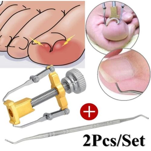 Coupe-Ongles Incarnés Pour Pédicure, Outil De Soins Des Pieds, Correction Des Ongles, Coupe-Ongle, Pour Acronyx Orthopédique, Dissolvant De Peau Morte, Podiétrie 