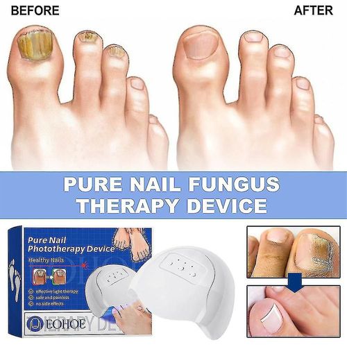 Appareil Laser Fongique Purenail, Appareil De Luminothérapie, Ongle Fongique Onychomycose Traitement Des Orteils, Soins Des Ongles
