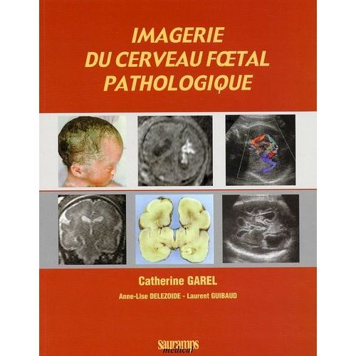 Imagerie Du Cerveau Foetal Pathologique