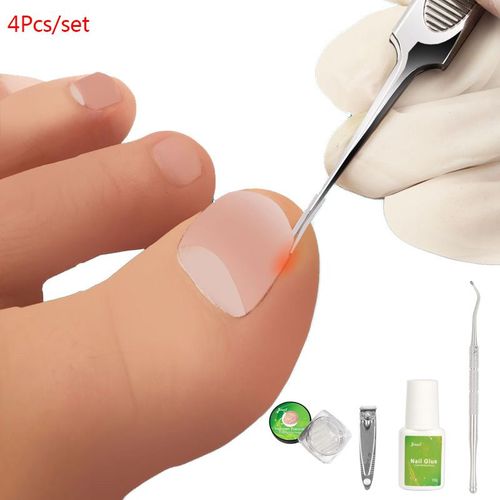 Ensemble De Correcteur D'ongles Pour Orteils, Pince D'extraction De Colle, Pince À Double Tête + Coupe-Ongles + Colle + Pince À Lisser, 4 Pièces 