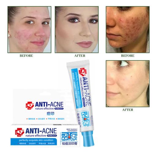Crème Anti-Acné À Base De Plantes, Dissolvant De Boutons, Médecine Efficace, Crème Traditionnelle, Rétrécissement Des Pores, Gel De Traitement Chinois, Élimination M0t7 