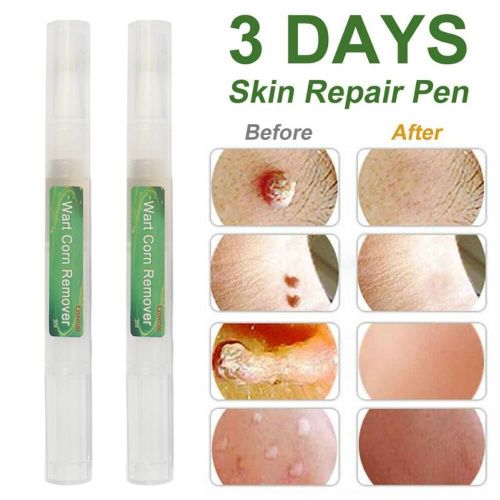 Stylo Dissolvant De Verrues De Maïs, Nettoyage Des Verrues Génitales, Grains De Beauté, Papillome, Traitement Médical, Élimination Du Plâtre, Liquide, Soins De Santé Pour La Peau 