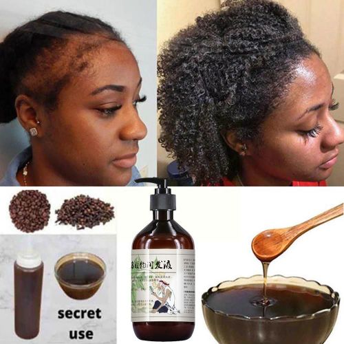 Shampooing Anti-Démangeaison Pour Hommes, Huile De Contrôle, Soin Capillaire, Après-Shampoing, Traitement Efficace, Racine, Fort, S1t2, 300ml 