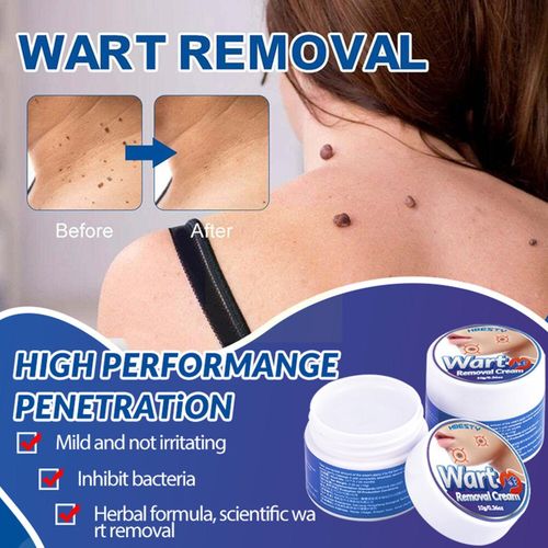 Crème Anti-Verrues Sans Douleur, Dissolvant Pour Verrues, Grains De Beauté, Maïs, Onguent, Soins Pour La Peau, A5m4 