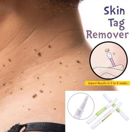 Traitement Des Verrues Génit, Élimination Des Papilloms, Liquide Des Verrues De La Peau, Dissolvant Contre Les Grains De Beauté, Tslm2 