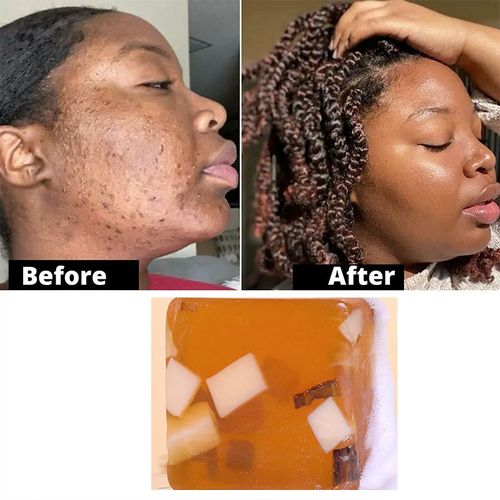 Traitement Au Savon Noir Africain Pour Le Visage, 2 Pièces, Fait À La Main, Anti-Revolver, Imperfections Lisses, Beurre De Karité, Hydratant En Douceur, Soins De La Peau, Bain 