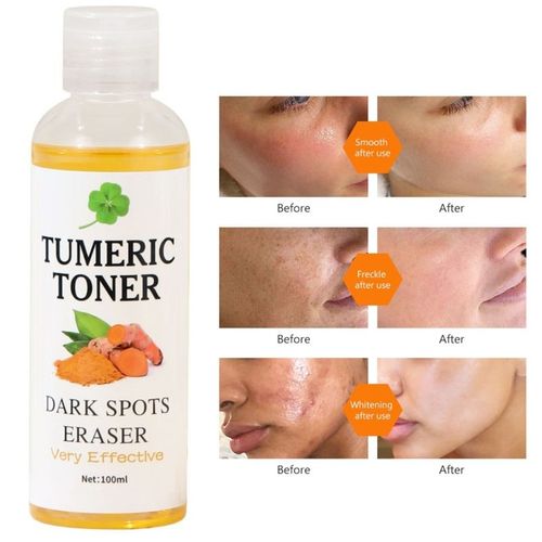 Dissolvant De Taches Foncées, Toner, Estompe Les Imperfections, Hydratant, Éclaircissant, Acné, 100ml, D2ta 