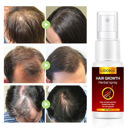 Produits De Croissance Capillaire Au Gingembre, Spray Anti-Perte De Cheveux, Soins De Beauté À Croissance Rapide, Prévient La Perte De Cheveux, Huile De Traitement Du Cuir Chevelu, Soins De Réparation 