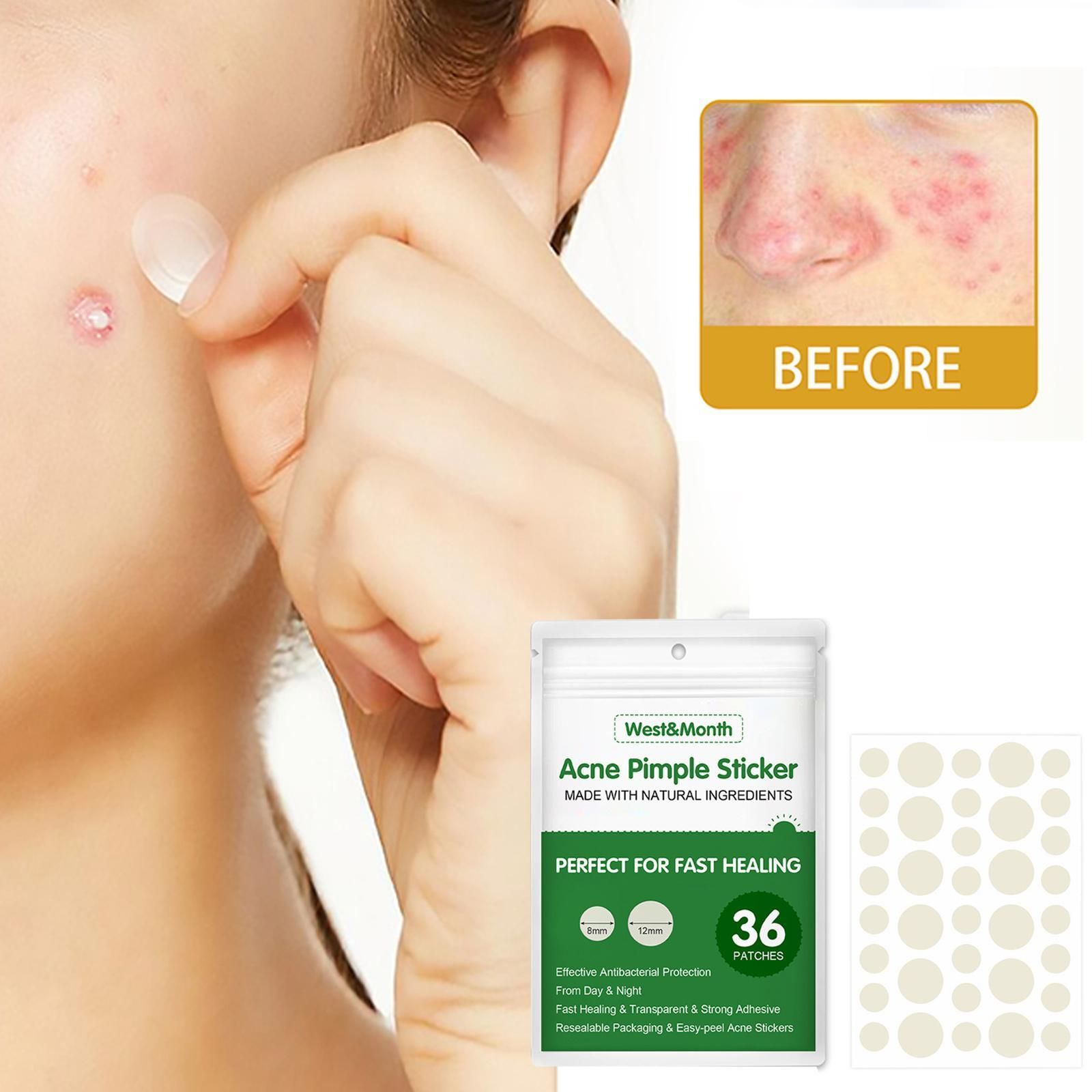 Patchs Autocollants Pour Boutons D'acn, 36 Pices, Patch Im...
