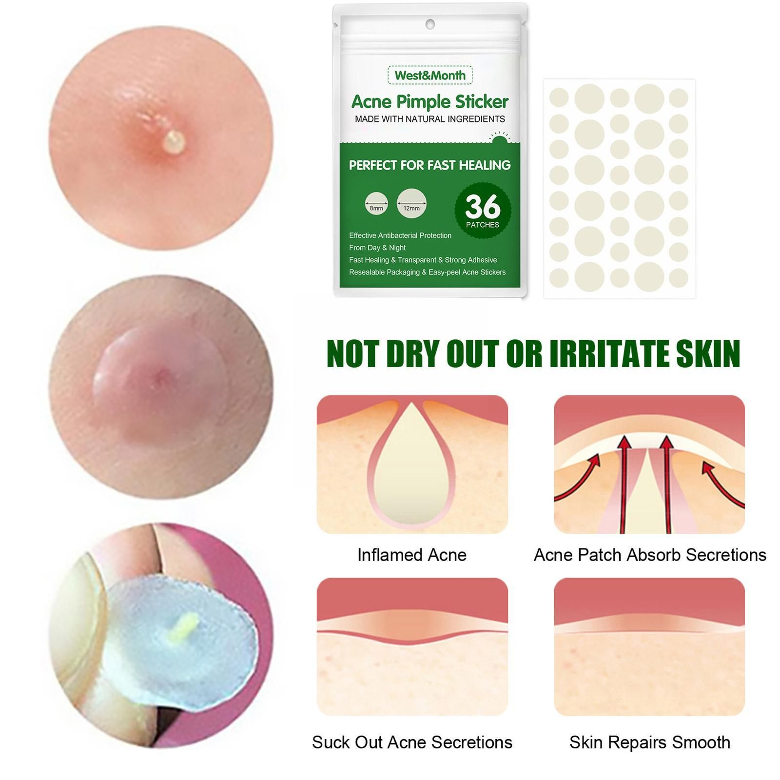 Patchs Autocollants Pour Boutons D'acn, 36 Pices, Patch Im... - 4