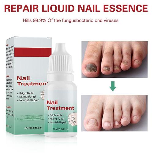 Liquide De Réparation Des Ongles 10ml, Champignon, Cadeau Parfait, Léger, Portable, Solution Nourrissante, Fournitures De Soins Professionnels 