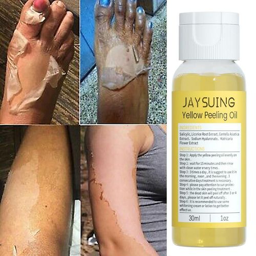 Huile De Peeling Jaune Pour Extinction Linge, Soins De Beauté Blanchissants, Dissolvant De Peau Foncée, Mélanine Des Bras Et Des Genoux, Wiltshire, Livraison Gratuite, 30ml 