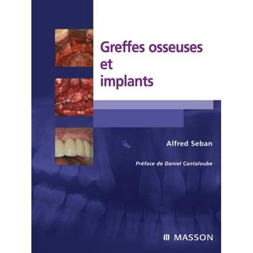 Greffes Osseuses Et Implants