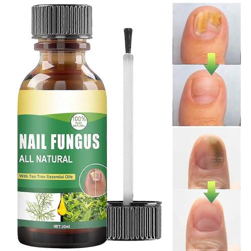 30ml Traitement De Champignon DOngle DOrteil, Huile DArbre  Th Pour Champignon DOngle, Essence De Soin De Solution Antifongique Pour Les Ongles Tw