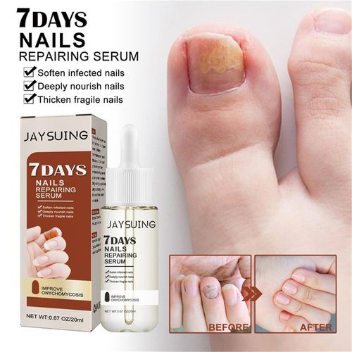 Vernis À Ongles 7 Jours Croissance Des Ongles Et Sérum De Renforcement, Essence De Réparation Des Ongles, Croissance Des Ongles D¿Orteil, Ongle D¿Orteil Pour Réparer Les Ongles Endommagés Et Décolorés 