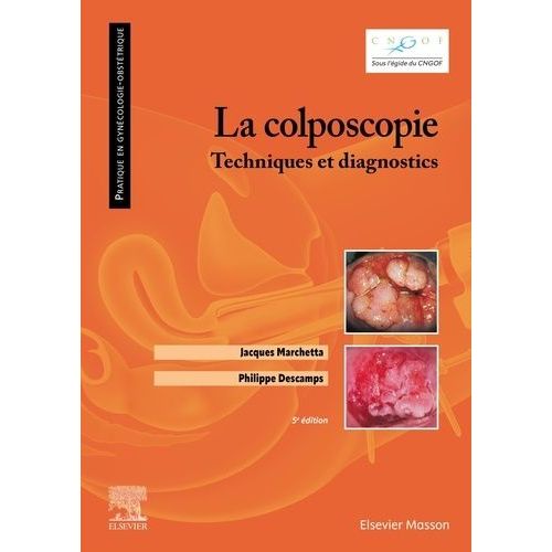 La Colposcopie