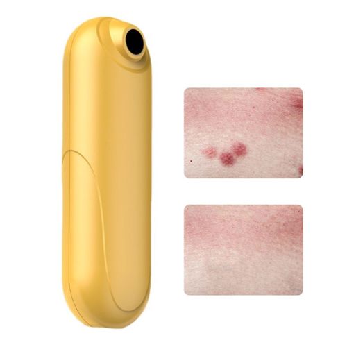 Hjlian Outil De Soulagement Des Demangeaisons Dues Aux Piqures D'insectes, Suceur De Piqures De Moustiques Rechargeable Par Usb, Sans Produits Chimiques, Pour Les Piqures D'insectes, D'abeilles Et De Guepes 