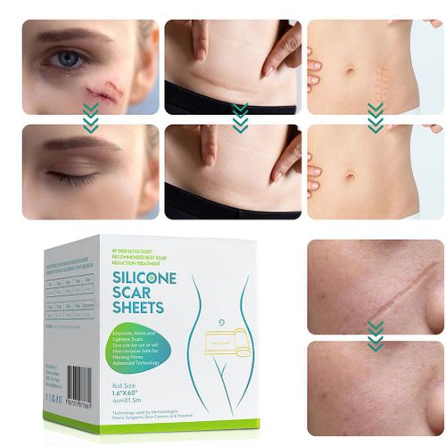 Ruban adhesif en silicone non irritant pour eliminer les cicatrices, ideal pour les brulures, les cheloides et l'acne