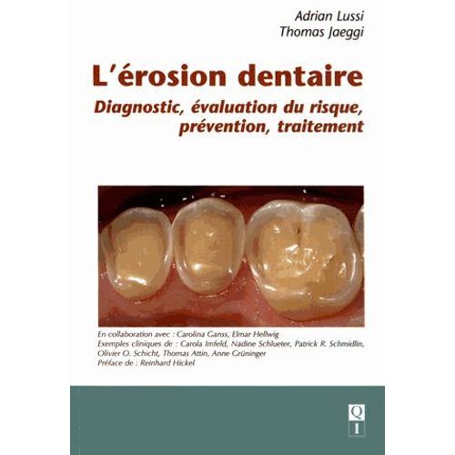 L'érosion Dentaire - Diagnostic, Évaluation Du Risque, Prévention, Traitement