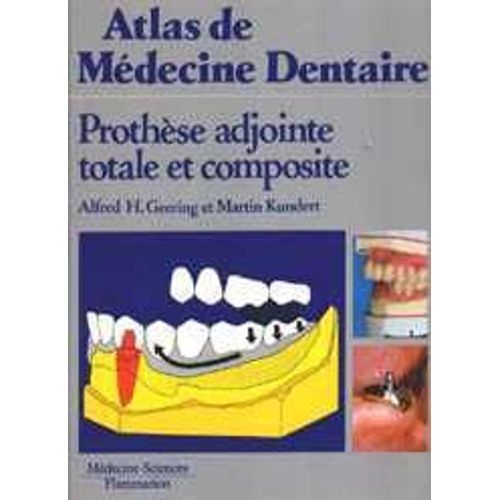 Prothèse Adjointe Totale Et Composite