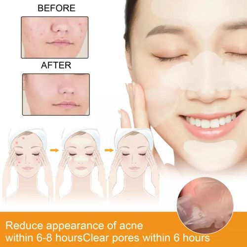 Bande Autocollante Dissolvant D'acn Par Hydrocollode, 10 Ensembles, Traitement De L'acn, Patch Propre, Acement, Rtrcissement Des Pores Du Visage, O6y9