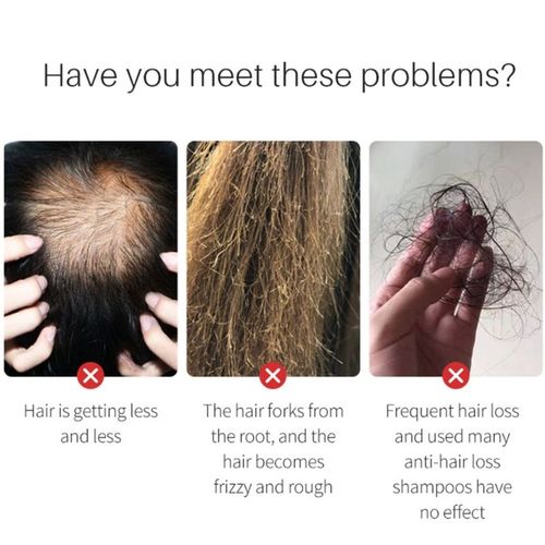 Essence Pour La Croissance Des Cheveux, 30ml, Liquide, Gingembre Naturel, Spray De Rparation, Soins Pour Cheveux Endommags