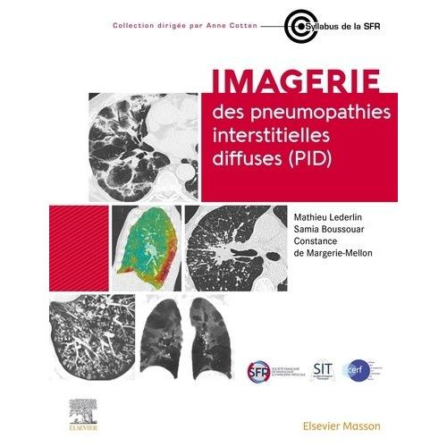 Imagerie Des Pneumopathies Interstitielles Diffuses (Pid)   de Lederlin Mathieu  Format Beau livre 
