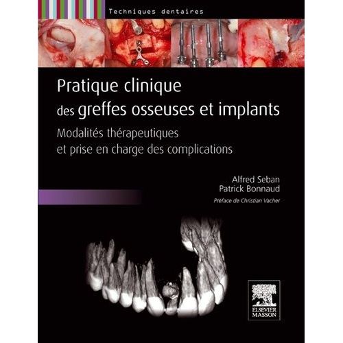 Pratiques Clinique Des Greffes Osseuses Et Implants - Modalits Thrapeutiques Et Prise En Charge Des Complications   de Seban Alfred  Format Reli 
