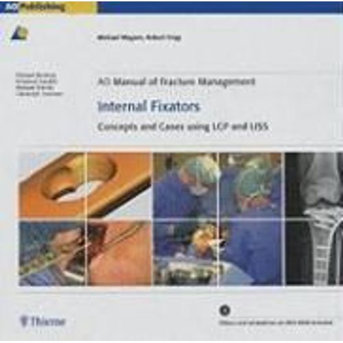 Ao Manual Of Fracture Management: Internal Fixators: Concepts And Cases Using Lcp/Liss [With Dvd Rom]   de Michael Wagner  Format Reli 
