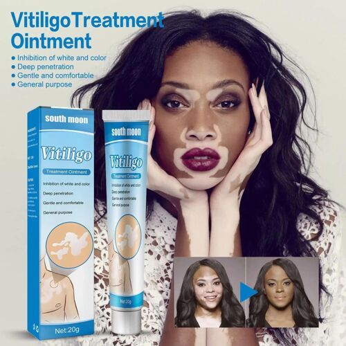 20g - Pommade Au Vitiligo Aux Extraits De Plantes, Élimine La Teigne, Crème Pour Enlever Les Taches Blanches, Traitement Des Taches Cutanées, Maladie De La Leucoplasie, 20g, D9g5