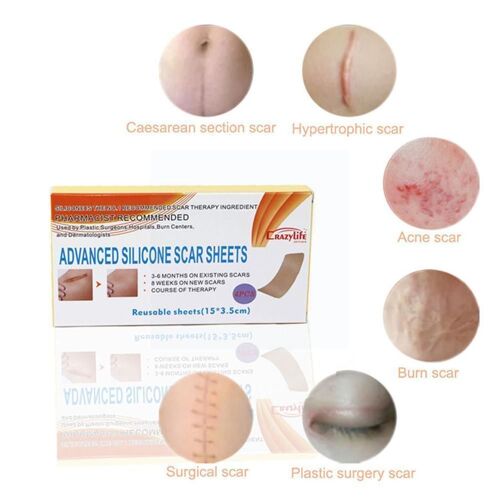Feuille D'élimination Des Cicatrices Pour Vergetures, Patch De Réparation De La Peau, Traitement De L'acné, Autocollant En Silicone Lavable Réutilisable D9n1, 1 Boîte 