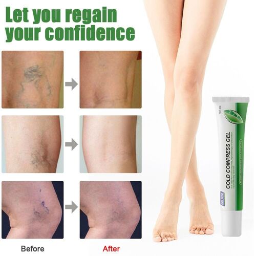 Stylo De Traitement Pour Varices, Kit Apaisant Pour Les Jambes, Pommade, Soulage Le Gonflement Des Varices 