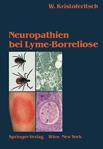 Neuropathien Bei Lyme-Borreliose