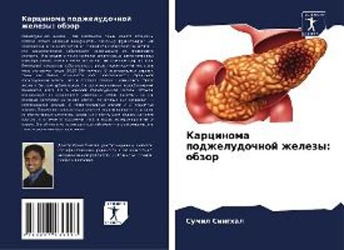 Karcinoma Podzheludochnoj Zhelezy: Obzor