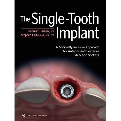 The Single-Tooth Implant - A Minimally Invasive Approach For Anterior And Posterior Extraction Sockets