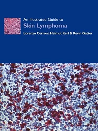 An Illustrated Guide To Skin Lymphoma