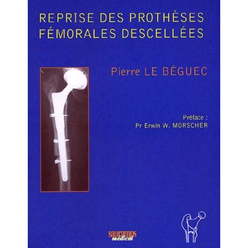 Reprise Des Prothèses Fémorales Descellées - Avec Tiges Fémorales Press-Fit