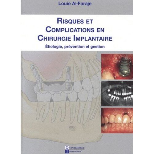 Risques Et Complications En Chirurgie Implantaire - Etiologie, Prévention Et Gestion
