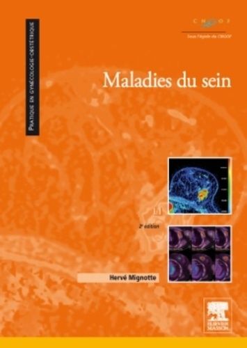Maladies Du Sein