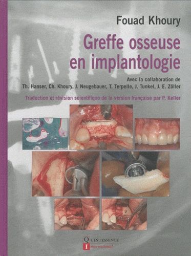 Greffe Osseuse En Implantologie