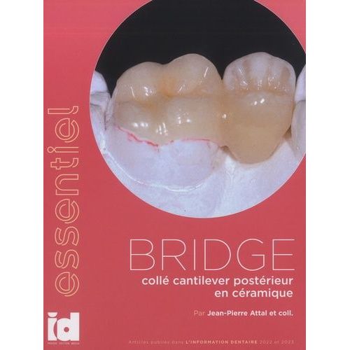 Bridge Collé Cantilever Postérieur En Céramique